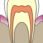 397px-cavities_evolution_1_svg
