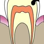397px-cavities_evolution_3_svg2