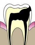 397px-cavities_evolution_5_svg2