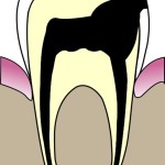 397px-cavities_evolution_5_svg3